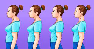 This hump on back of neck is the result of poor posture, slumping, and weak back and core muscles. What Is Dowager S Hump And How To Fix It It S Not Only About Your Posture