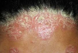 सोरियासिस (awa) enfermedad inflamatoria crónica de la piel de origen autoinmune (es); Psoriase Do Couro Cabeludo Dr Cesar Bimbi