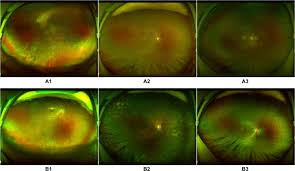 Retinal imaging takes a digital picture of the back of your eye. Deep Learning For Detecting Retinal Detachment And Discerning Macular Status Using Ultra Widefield Fundus Images Communications Biology