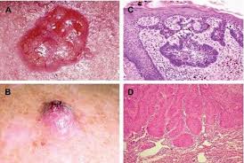 Treatment of hirsutism and acne in. Clinical Features Related To Xeroderma Pigmentosum In A Brazilian Pati Tacg