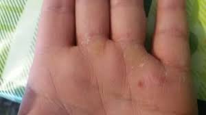 Eczema este o afectiune ce apare la nivelul pielii, fiind caracterizata prin niste leziuni destul de inestetice, ce produc disconfort leziunile de pe piele produc niste mancarimi uneori insuportabile, trezind pacientul noaptea din somn. Dermatita Dishidrotica Wasatchpremiermovers Com