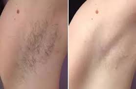 Because a laser is burning portions of the treated hair. Hair Removal By Lasers In Pune Hair Removal Treatment In Pune