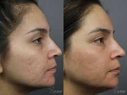 Acne Scars Before & After Gallery