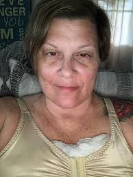 Day 3 post op and the pain is excruciating and brutal! ￼