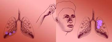 Are the signs and symptoms the same? Can Lung Cancer Be Misdiagnosed As Pneumonia