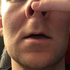 The anterior nasal spine, or anterior nasal spine of maxilla, is a bony projection in the skull that serves as a cephalometric landmark. Can A Rhinoplasty Improve My Ability To Smile If The Anterior Nasal Spine Is Reshaped And Bone Removed Photo