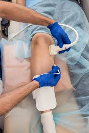 Image result for Radiofrequency Surgery