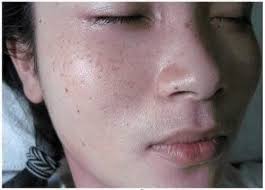 Ai bị đồi mồi, đốm đen,nâu thì liên hệ với em nhé 🌸Em mới về ít Kem trị  ĐỒI MỒI của Nga 👉SP chất lượng chỉ bôi lên vị trí cần tẩy