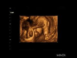 Menggugurkan kandungan atau dikenal dengan istilah aborsi kerap diidentifikasi sebagai cara untuk mengakhiri. Detail Gambar Usg 4d Bayi Laki Laki 27 Minggu Dalam Kandungan Lucu Dan Bik