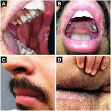I got a very painful ulcer ( white in the middle,, probably 1 or 2 mm in size ) situated just beneath the gum, lower teeth (inner side of gums, not outside adjacent to lips) and not on my lips, tongue or palate, which i have seen. Secondary Syphilis Lest We Forget It Postgraduate Medical Journal