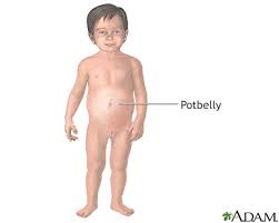 Potbellies And Toddlers Information Mount Sinai New York