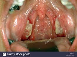 Epstein Barr Virus Stockfotos Und Bilder Kaufen Alamy