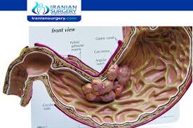 Normally, the body controls cell growth and division. Gastric Cancer Stomach Cancer Treatment Stomach Cancer Surgery