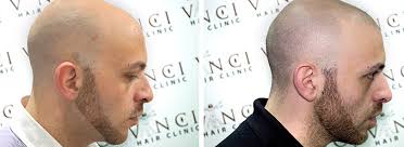 Choose one of our hairstyles for balding men, thinning hair, or mphl. Medical Clinic Create Hair Tattoos For Bald Men Life Guide