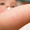 Idiopathic thrombocytopenic purpura (itp), sering dibahagikan kepada dua itp berbeza mengikut akut. 1