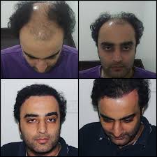 One Of Our Happy Hair Transplant Friends Who Came To Us To Show His Result After The Year Of Is Ha Hair Transplant Best Hair Transplant Hair Transplant Results