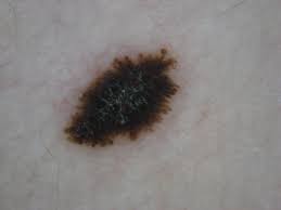 Image result for Spitz Nevus