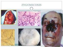 Las personas afectadas pueden presentar fiebre. Clase 21 Mucormicosis Hialohifomicosis Feohifomicosis Peniciliosi