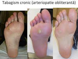 Tratamentul ciupercii piciorului depinde de severitate si forma clinica (una din cele trei anterior amintite). Bataturile Piciorului Cauze Si Tratament