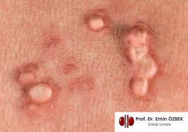 Image result for genital warts