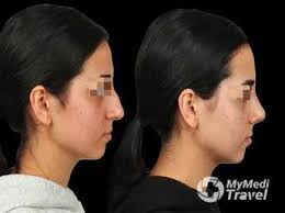 Rhinoplasty Clinics in Istanbul