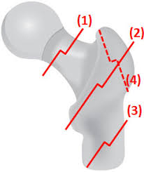 Pediatric femur fractures, major pelvic trauma. Fracture De La Hanche