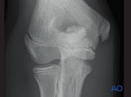 Image result for Humerus Growth Plates