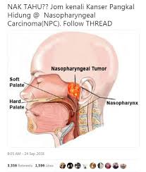 Polip yang biasanya diperlakukan sebagai tumor jinak, sedangkan sinusitis. Kanser Pangkal Hidung Doktor Ini Pesan Peminat Ikan Kering Kena Peka Dengan Gejalanya Vanilla Kismis