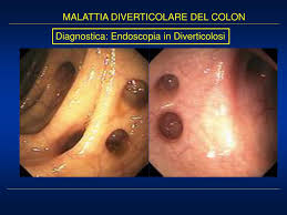 Ma andiamo a vedere nei particolari cosa comporta questo problema di salute. Ppt Malattia Diverticolare Del Colon Powerpoint Presentation Free Download Id 1406113