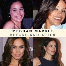 We talk to a woman who had a nose job to find out what it's really like to get plastic surgery. The Duchess Of Sussex Aka Meghan Sisu Aesthetic Clinic Facebook