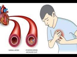 6 Foods That Will Naturally Clean And Protect Your Arteries From Heart Attack And Stroke Youtube Remove Plaque Arteries Heart Disease