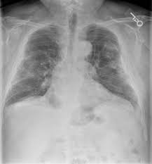 This page provides essential information . Asbestos Related Pleural Disease Pleural Plaques And The Holly Leaf Sign Radiologypics Com