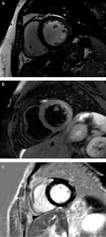 Check spelling or type a new query. Sindroma De Takotsubo Ou Miocardite Aguda O Papel Da Ressonancia Magnetica Cardiaca Sciencedirect