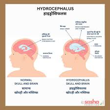 Image result for Hydrocephalus