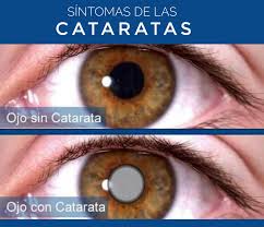 Resulta muy difícil para una persona con buena vista, imaginarse vivir en un mundo que se vea nublado y tenebroso. Sintomas De Las Consultorios De Ojos Castillo Facebook