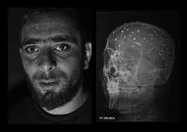 By bb gun i will assume you mean something along the lines of a daisy red ryder and not a high velocity pellet rifle. Pellet Gun Victims In Kashmir Suffer From Eye Injuries Time