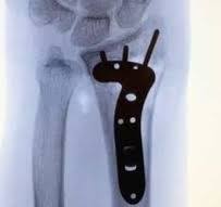 Volar Locking Plate Fixation of Distal Radius Fractures: A ...