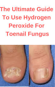 Ultimate Guide Using Hydrogen Peroxide For Toenail Fungus
