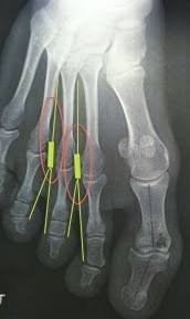 Le nerf le plus souvent atteint se situe entre le 3e et le 4e orteil, parfois entre le 2e et le 3e. Traitement Douleur Pied Syndrome De Morton Avignon Orange