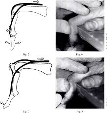 Image result for Elson Extensor Tendon Test