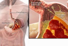 Smoking and obesity increase a. Gerd Acid Reflux Heartburn Symptoms Treatment Diet