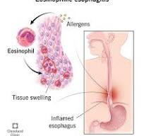 Eosinophilic Esophagitis: What it Is, Symptoms & Treatment