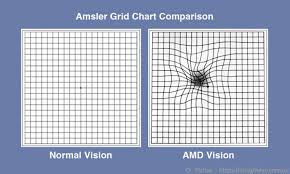 Age Related Macular Degeneration Amd