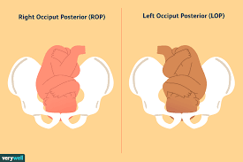 In left occiput anterior fetal position, the fetus heart sound is located at: Fetal Positions For Labor And Birth
