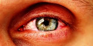 Augeninfarkt Ursachen Symptome Und Therapie Heilpraxis