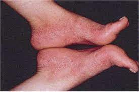 Papular Purpuric Gloves And Socks Syndrome Polymerase Chain Reaction Demonstration Of Parvovirus B19 Dna In Cutaneous Lesions And Sera Journal Of The American Academy Of Dermatology