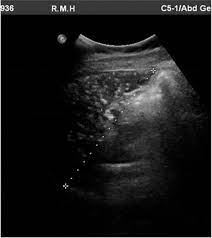 Splenic Calcification In Systemic Lupus Erythematosus Bmj Case Reports