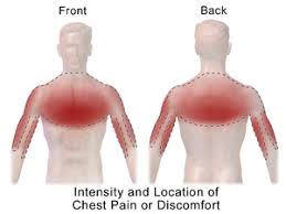 Chest Pain Wikipedia