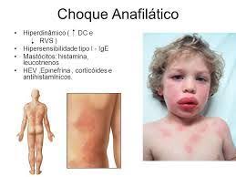 Só o minha vida oferece os melhores conteúdos de choque anafilático. Resultado De Imagem Para Choque Anafilatico Sistema Circulatorio
