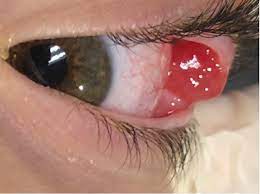 We did not find results for: Conjunctival Pyogenic Granuloma A Case Series Of 2 Pediatric Patients Consultant360